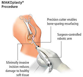 Robotically Assisted Knee Surgery