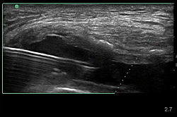 Ultrasonic Diagnosis and Injections